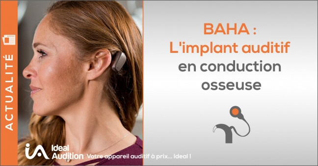 conduction osseuse : l'implant BAHA - Ideal Audition